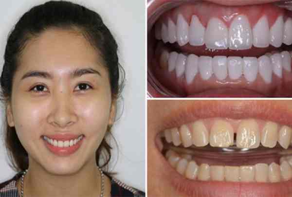 Nữ giới răng thưa Nữ giới răng thưa