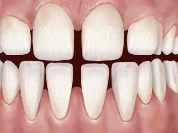 Răng thưa là gì? Dấu hiệu nhận biết chuẩn xác răng thưa tướng số