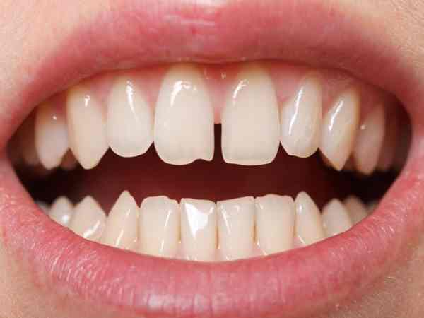 Răng thưa trong tình duyên và hôn nhân Răng thưa trong tình duyên và hôn nhân